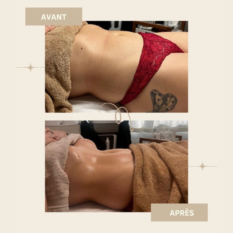 résultat avant après d'un massage lymphatique au niveau du ventre